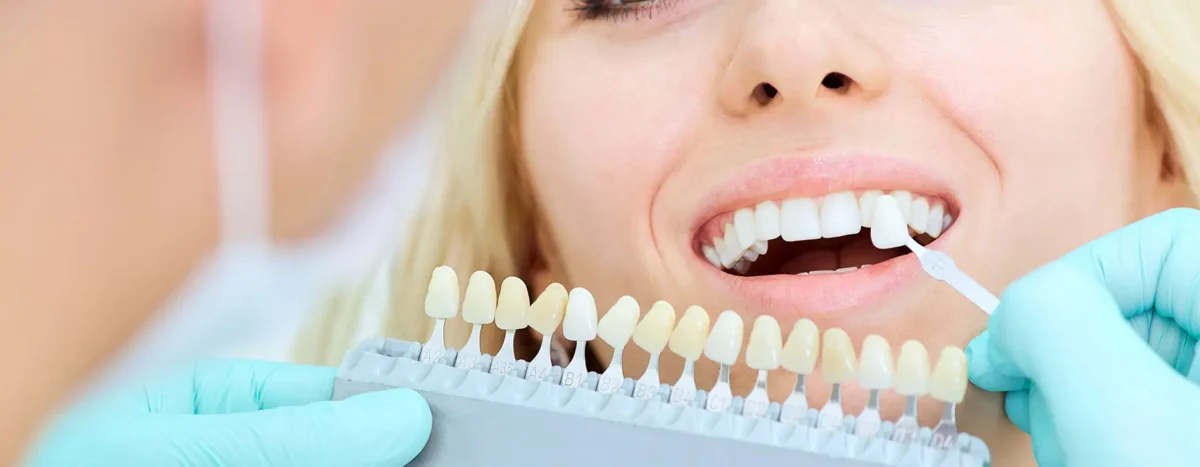 blanqueamiento dental