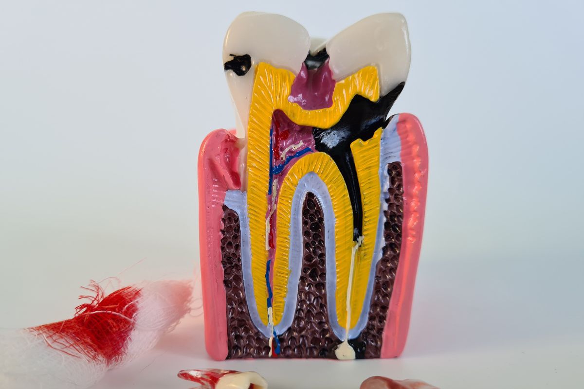 infecciones de raíz