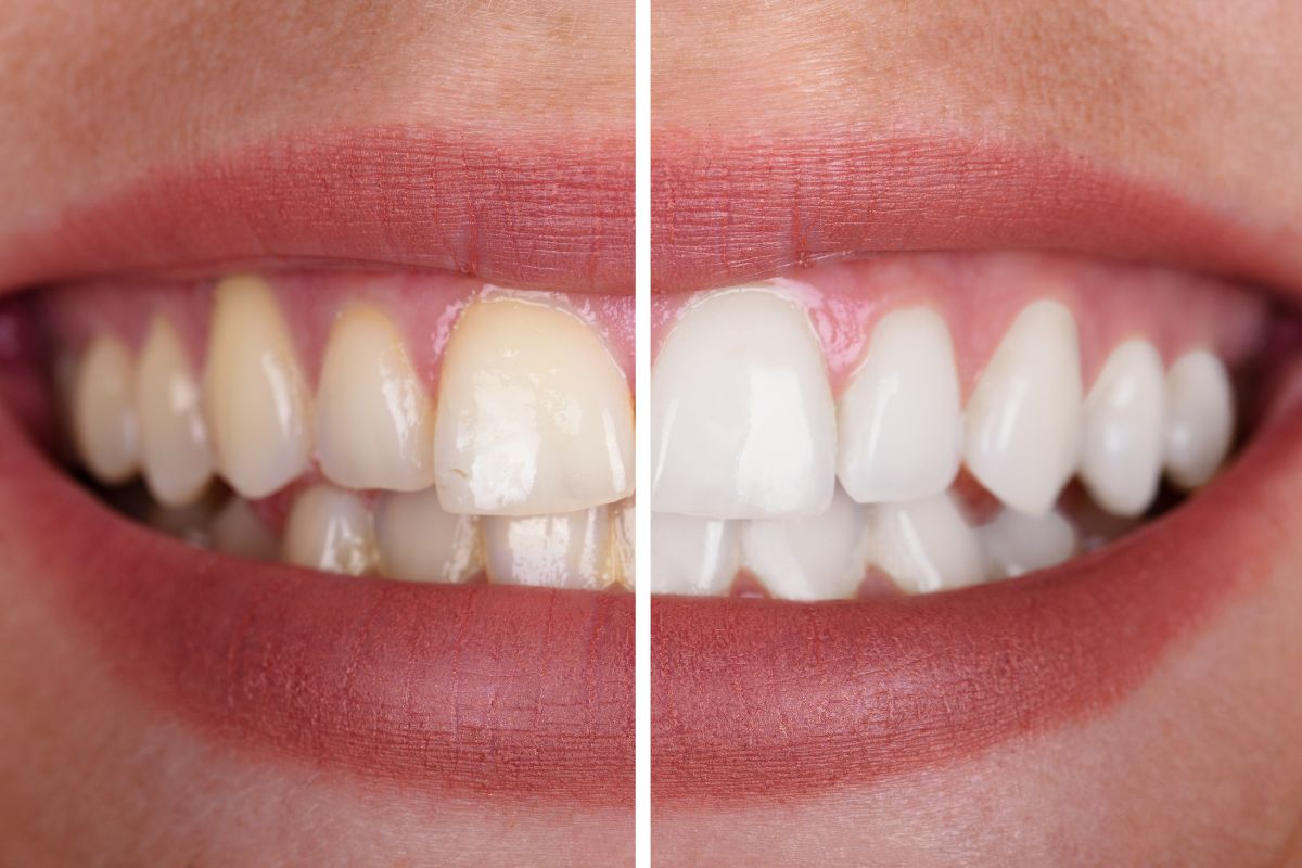 Blanqueamiento dental_ mitos y realidades